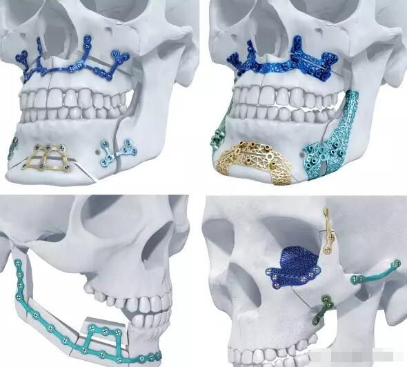 3D 打印新征程：Materialise 與 Feops 的融合創新